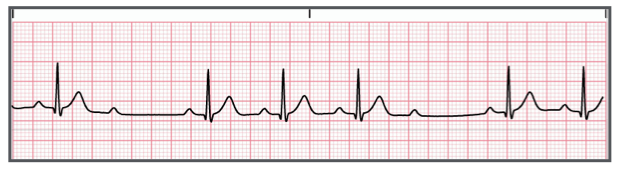 <p>Identify the above waveform:</p><p>a. First degree heart block</p><p>b. Third degree heart block</p><p>c. Second degree heart block type II</p><p>d. Second degree heart block type I</p>