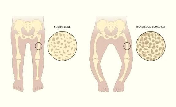 <p>A genetic mutation causing underproduction of collagen, resulting in brittle bones</p><p></p><p><u>Radiographic appearance</u></p><ul><li><p>decreased bone density</p></li><li><p>Bowing of the bones</p></li><li><p>Frequent and unexplained deformities leading to deformations</p></li></ul><p></p>