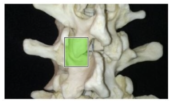 <p>The facet joint creates the intervertebral foramina. This joint is formed by the superior articular process of one vertabra and the inferior articular process of the vertebra directly aove. ANother name for the facet joint is the zygapophyseal joint. Injury to the facet joint can compress the psinal nerve that exits at the corresponding intervertebral formna, causing pian and muscle spasm along associated dermatome</p>