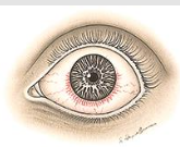 <p>redness more concentrates around limbus w/ deeper vessels<br>mod/aching/deep/photophobia pain, ↓vision, NO discharge, pupil SMALL/IRREG, </p>