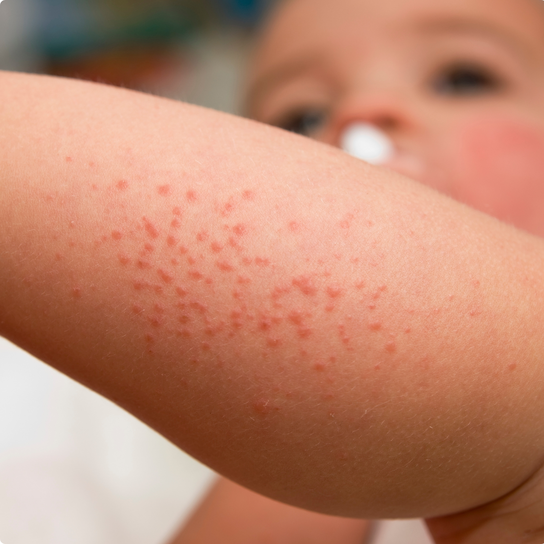 <p>rash</p>