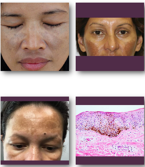<ul><li><p>Acquired hyperpigmentation of sun-exposed facial skin</p></li></ul><p>•Caused by UV exposure and hormonal influences</p><p>•Associated with pregnancy and hormonal therapy</p><p>•More common in women with darker complexions</p><p>•Results from increased melanin production</p>