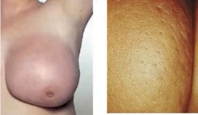 <p>What pathology?<br>and what characteristic change is seen on the right image?</p>
