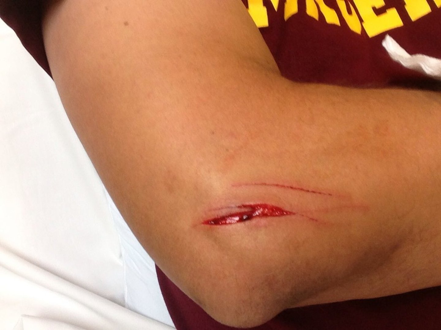 <p>deep cut or tear in skin</p>