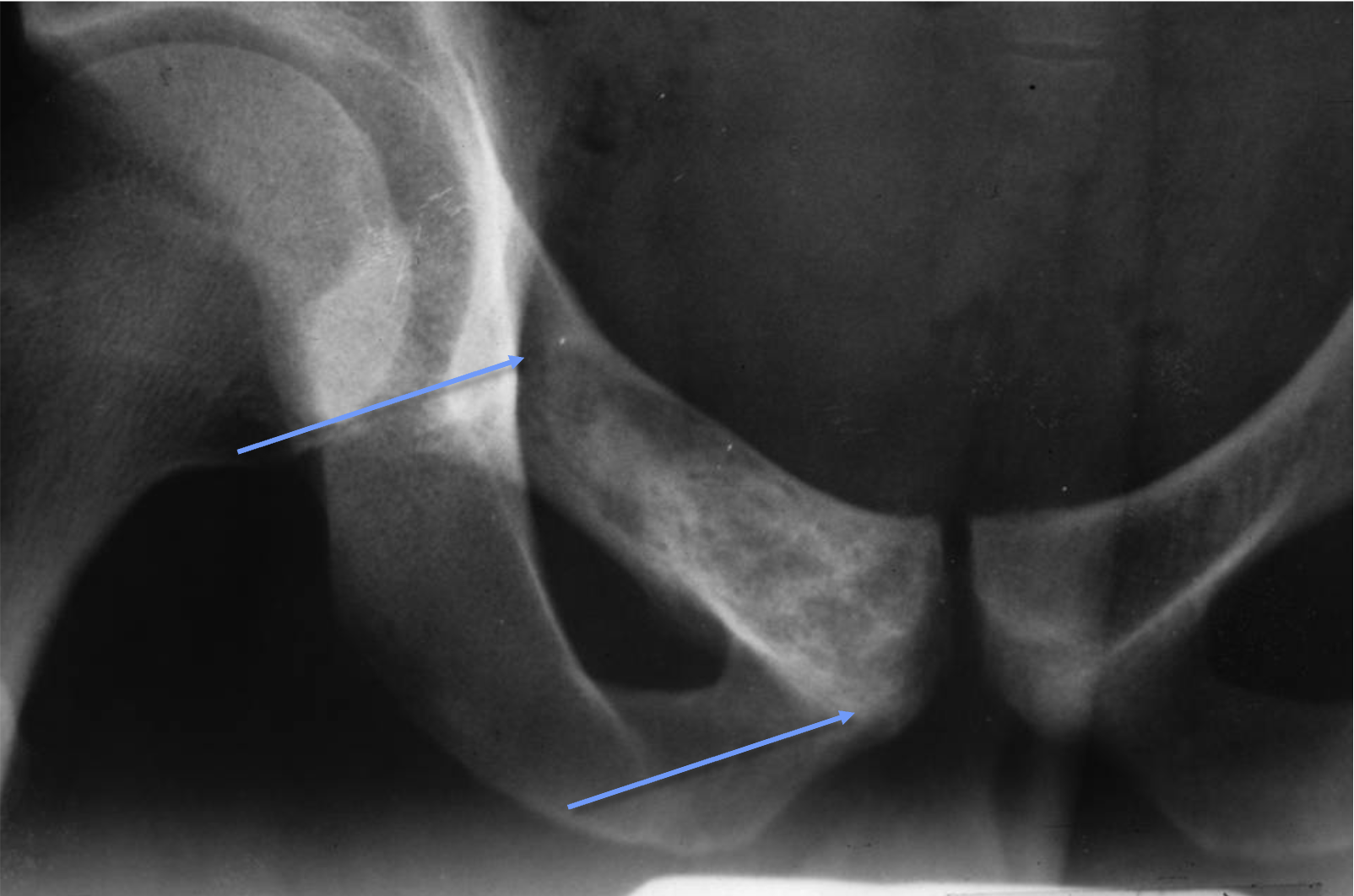 <p>What tumour like disorder is this, what can you see?</p>