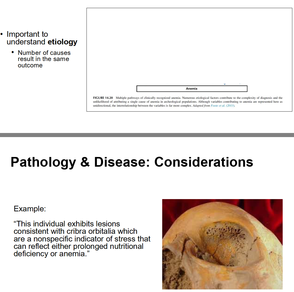 <ul><li><p>The study of disease. From the Greek pathos (suffering)</p></li><li><p>Ever-evolving, expanding understanding of how disease affects humans</p></li><li><p>We <strong>only observe lesions</strong> (NOT the disease itself)</p><ul><li><p>From skeletal remains, differential diagnosis is often as good as you can get</p></li></ul></li><li><p>Important to understand <strong>etiology</strong></p><ul><li><p>Number of causes result in the same outcome</p></li></ul></li><li><p>Example: “This individual exhibits lesions consistent with cribra orbitalia which are a nonspecific indicator of stress that can reflect either prolonged nutritional deficiency or anemia”</p></li></ul><p></p>