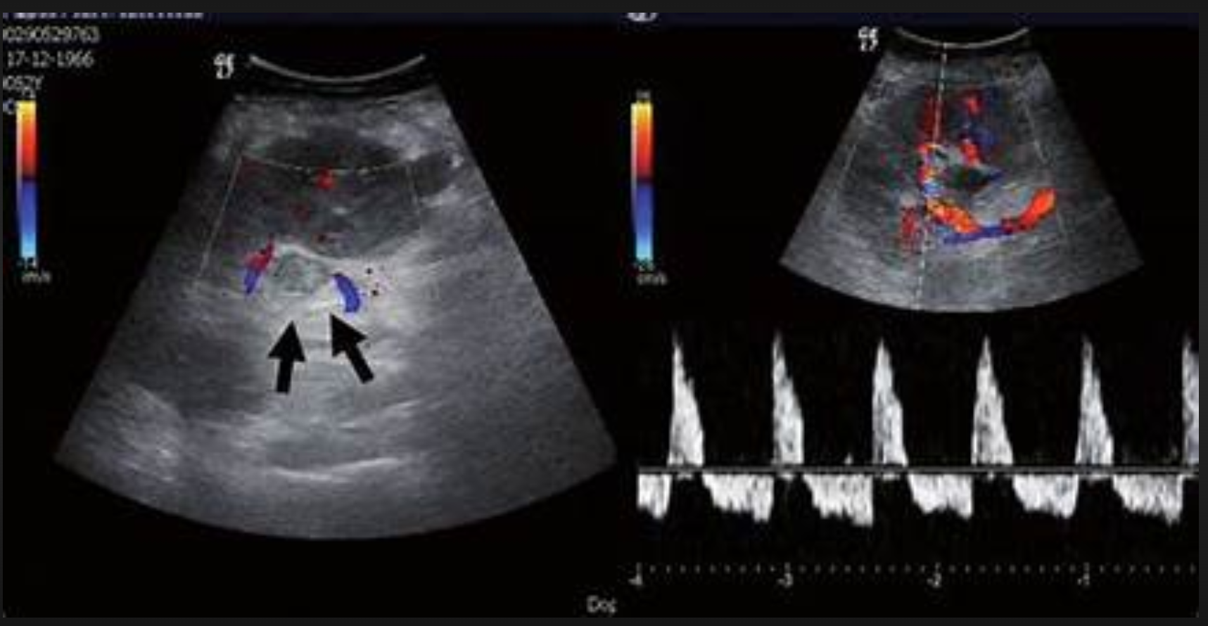 <p>- heterogenous, enlarged kidney</p><p>- enlarged renal vein</p><p>- absent doppler</p>