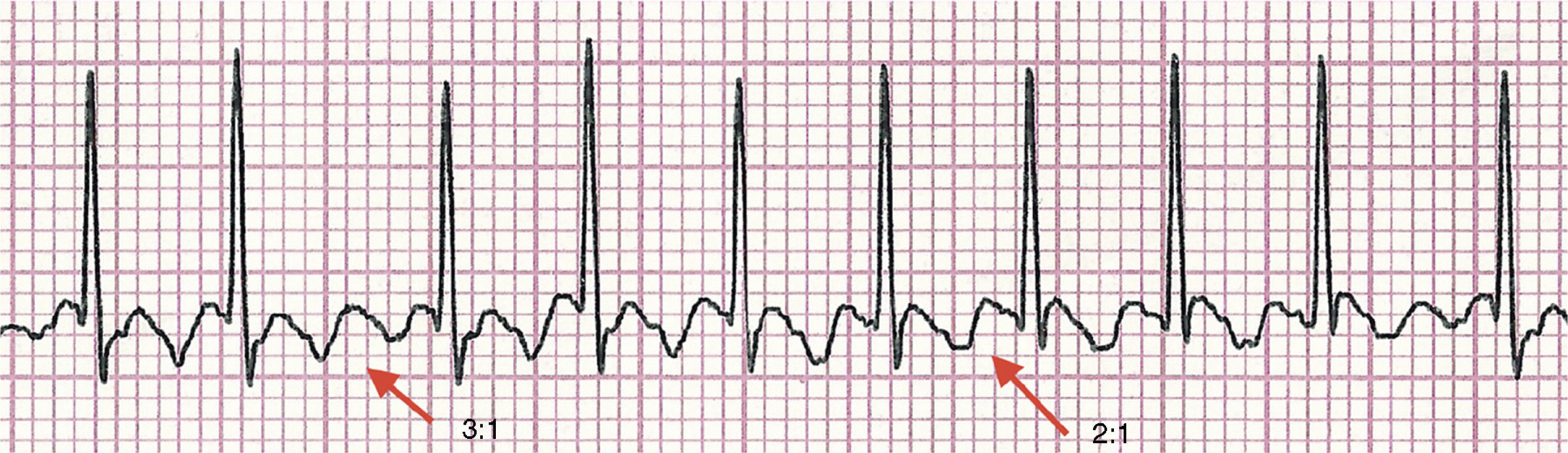 <p>Rate: atrial rate ~250-350, ventricular rate ~125-175</p><p>Regularity: usually regular, but may be variable </p><p>Saw toothed appearance </p>
