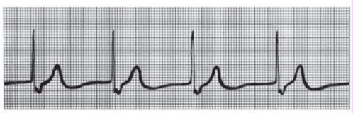 <p>SA node is nonfunctional, AV node takes over as main pacemaker (40-60 beats/min), P waves are absent</p>