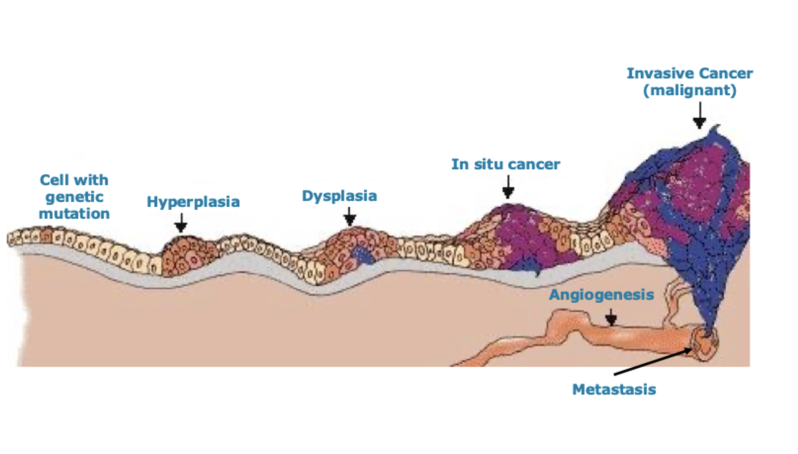 <p>Abnormal proliferation of cells</p>