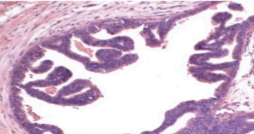 <p>What type of DCIS?</p>