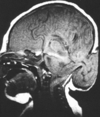 <p>occipital encephalocele, multicystic dysplastic renal disease, post-axial polydactyly.</p>