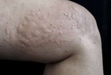 <p>A raised, transient area of localized edema in the skin.</p>