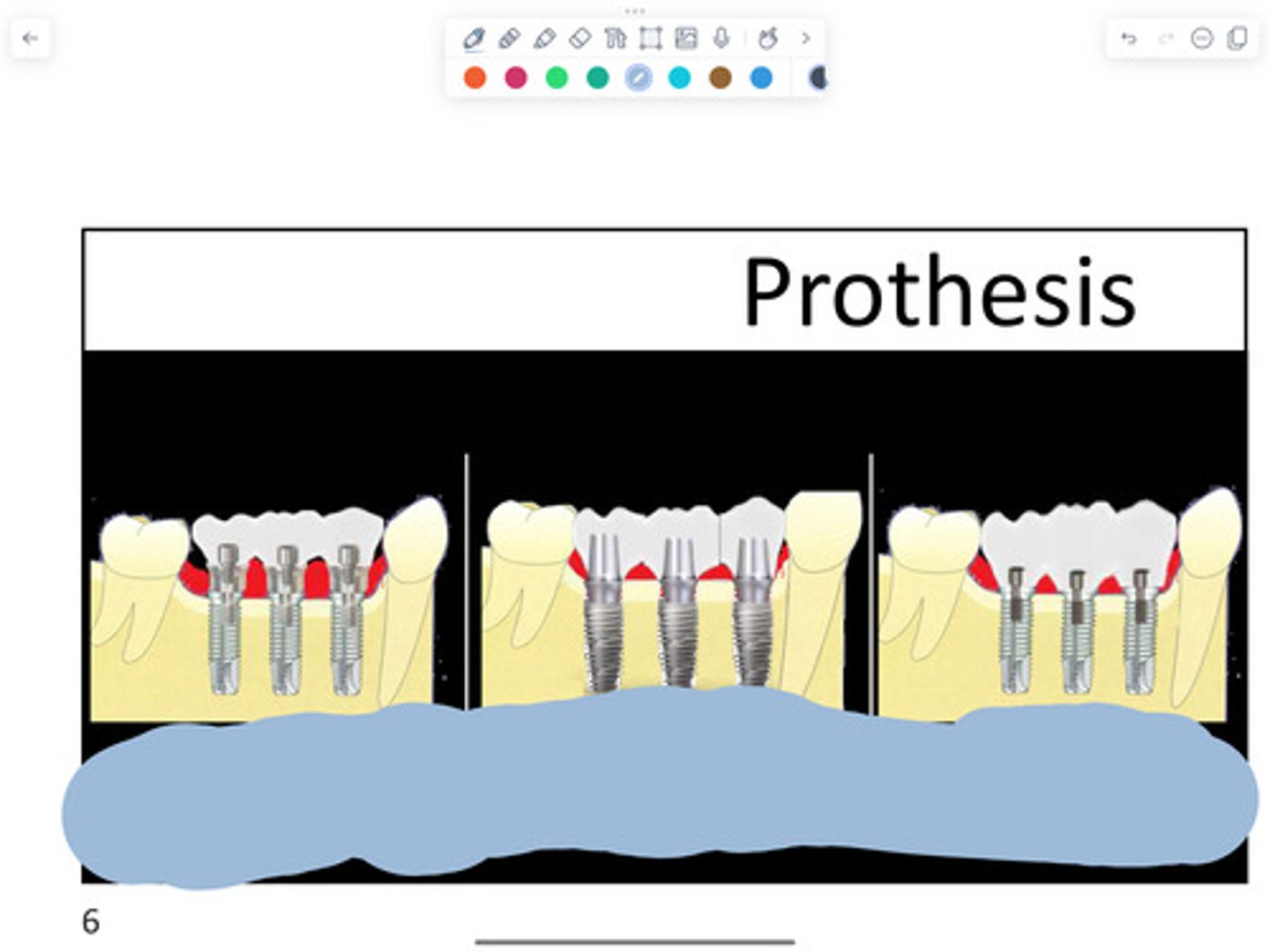 <p>What type of bridge is on the left?</p>