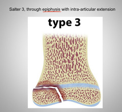 <p>Salter Harris type 3</p>