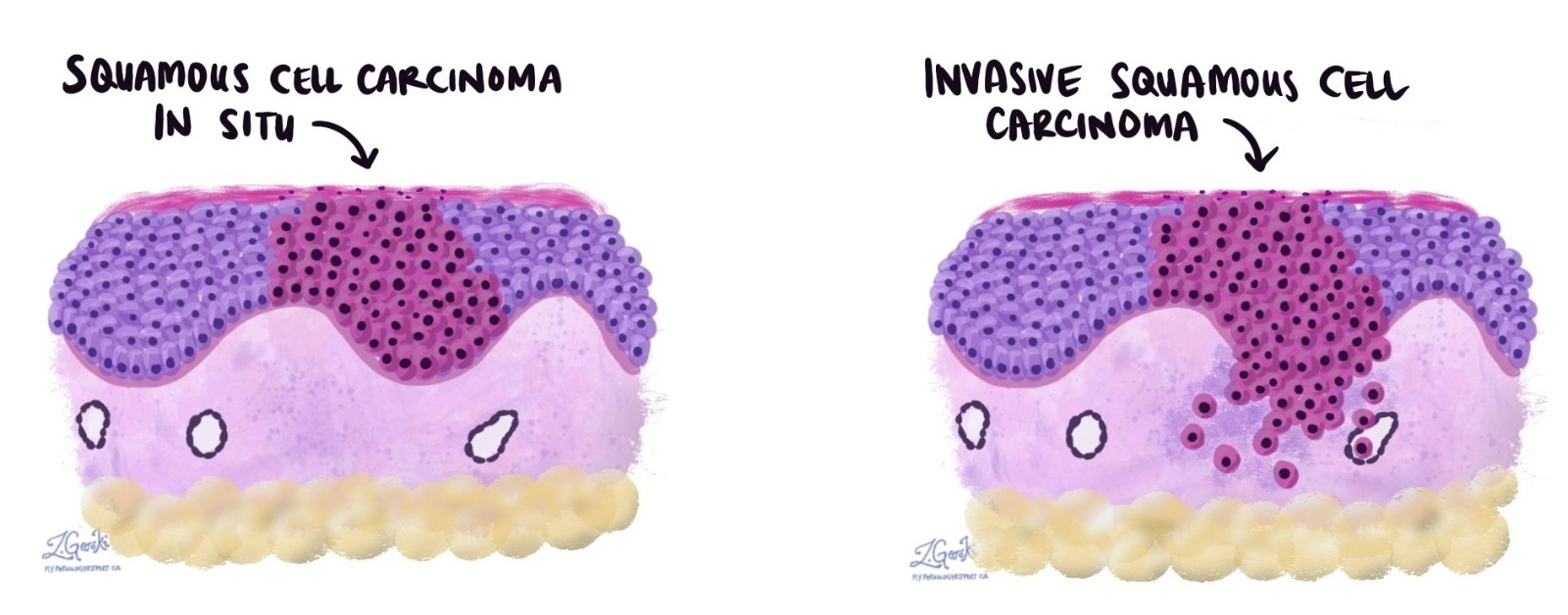 <p><span style="color: blue;"><strong><em><mark data-color="#a5f2af" style="background-color: rgb(165, 242, 175); color: inherit;"><sub><sup>Tumor maligno originado a partir de células epiteliales. Es el tipo de cáncer más frecuente.</sup></sub></mark></em></strong></span></p><p><strong><mark data-color="#f1f675" style="background-color: rgb(241, 246, 117); color: inherit;"><sub><sup>Fuente:</sup></sub></mark></strong><sub><sup> Real Academia Nacional de Medicina de España. Carcinoma [Internet]. Madrid: Real Academia Nacional de Medicina de España; 2012 [citado 10 de abril de 2026].</sup></sub></p>