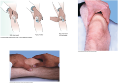 <p>milk fluid toward the medial side; small wave on lateral side suggests effusion.</p>