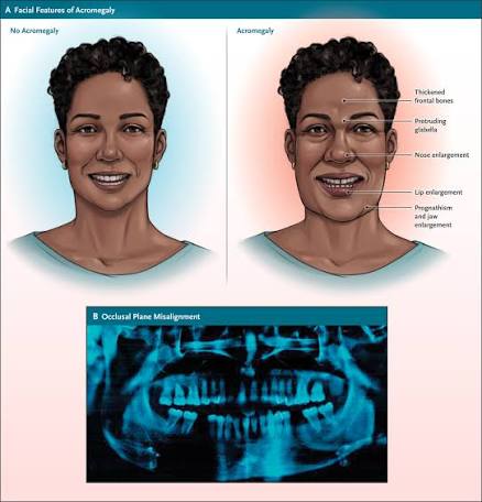 <ul><li><p>A condition where bones in the hands, face and feet are enlarged.</p></li><li><p>This is due to oversecretion/hypersecretion of GH</p></li></ul><p></p>