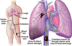 <p>pulmonary embolism</p>
