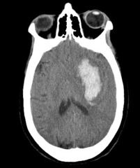 <p>More severe</p><p>Occurs when a vessel in the brain suddenly ruptures. Blood begins to leak directly into brain tissue and/or CSF</p>