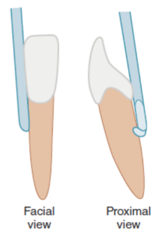 <p>Why simple shank for anterior teeth</p>