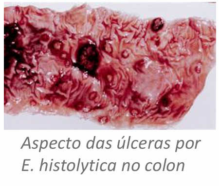 <p><span style="color: rgb(0, 0, 0);">encontra-se no lúmen do intestino grosso mas pode atingir outros orgãos </span></p><ul><li><p>colite</p></li><li><p>diarreia sanguinolenta</p></li><li><p>abcessos amibianos</p></li><li><p>pode levar à morte </p></li></ul><p></p>