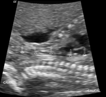 <p>several parallel echogenic lines within the thorax</p>