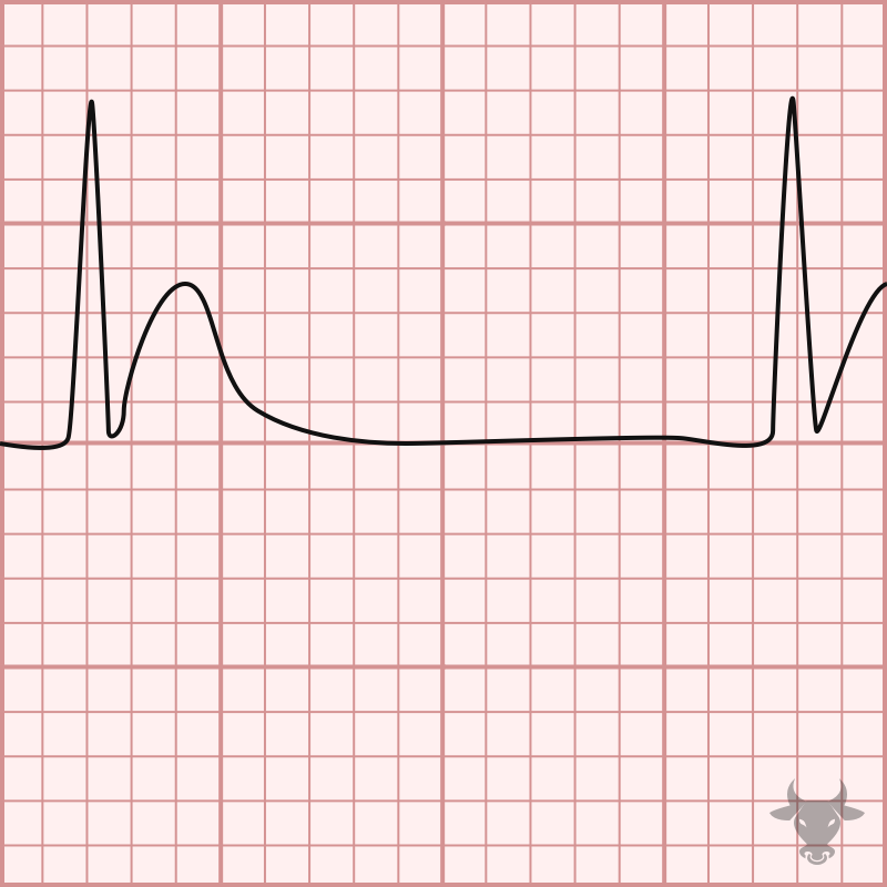 <p>Identify the electrolyte imbalance based on the ECG: </p><ul><li><p>Shortened ST segment</p></li><li><p>Shortened QT interval</p></li><li><p>Wide T wave</p></li></ul><p></p>