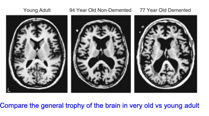 <ul><li><p><strong>Reduced brain volume (atrophy)</strong></p></li><li><p><strong>Widened sulci</strong> (more space between gyri)</p></li><li><p><strong>Enlarged ventricles</strong></p></li></ul><ul><li><p>In dementia:</p><ul><li><p>Changes are <strong>more pronounced</strong></p></li><li><p>Greater loss of <strong>cortical and subcortical tissue</strong></p></li></ul></li></ul><p></p>