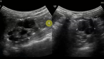 <p>A kidney affected by Multicystic Dysplastic Kidney is ___ and made up of multiple ___ and little if any normal renal ___.</p>