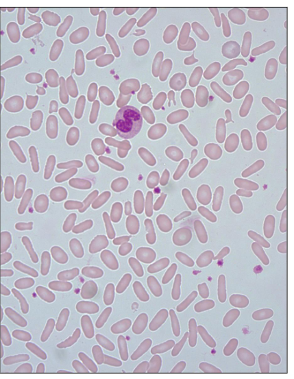 <p>Hereditary Elliptocytosis</p>