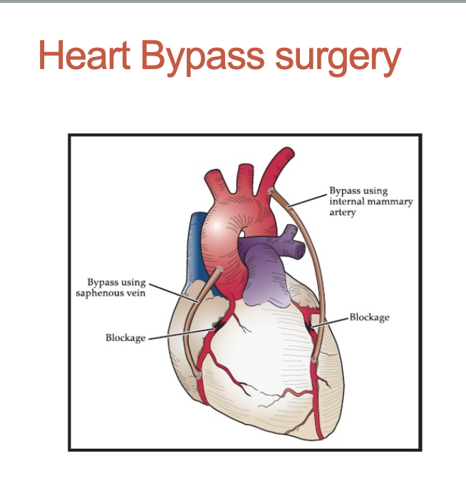 <p>What is heart bypass surgery? How does it work? How do we determine how many heart bypasses we do?</p>
