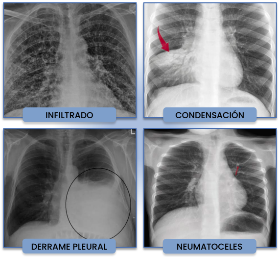 <ul><li><p><strong>Infiltrado alveolar: </strong>Imagen densa, homogénea o inhomogénea con posible broncograma aéreo.</p></li><li><p><strong>Condensación:</strong> Infiltrado alveolar confluente, homogéneo que compromete un lóbulo o segmento. Patrón de neumonía bacteriana típica (neumocócica).</p></li><li><p><strong>Derrame pleural:</strong> Opacidad homogénea que inicia en el <span style="color: red;">fondo del saco costofrénico </span>y asciende si aumenta. Neumonía complicada.</p></li><li><p><strong>Neumoatoceles:</strong> Imagen redondeadas de pared fina dentro de una consolidación. Neumonía complicada (ej: necrotizando por aureus).</p></li></ul><p></p>