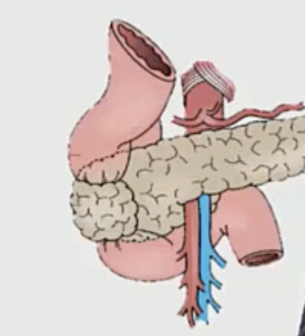 <p>Then the pancreas can twist around the duodenum, and this leads to a condition called anular pancreas, where food cannot pass down into the duodenum.</p>