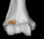 <p>the notch on top of the capitulum</p><p>Name this depression</p>