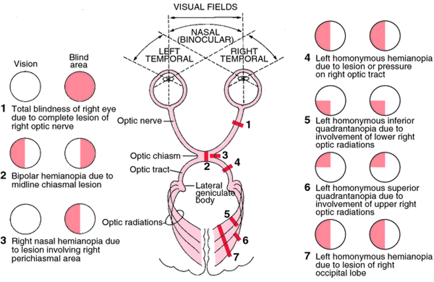 <p>L inferior homonymous quadrantanopia</p>