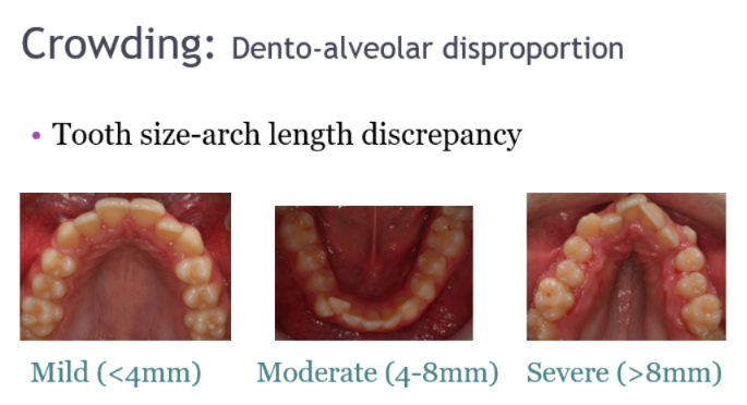 <p>How much space is missing for all teeth to be aligned within the length of the arch</p><p>“ There would need to be 8 more mm in the arch for all the teeth to be comfortably aligned”</p><p></p>