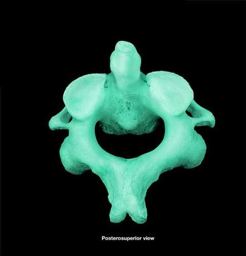 <p>What part of the cervical vertebrae is this?</p>