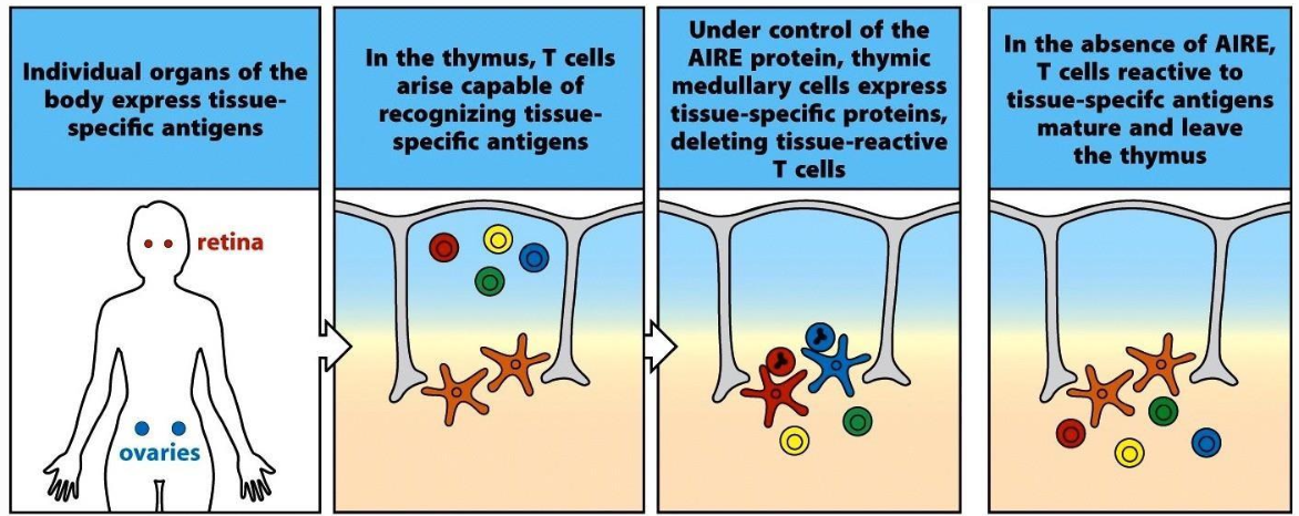 <p><span>APS results from genetic defects in the AIRE gene (found in Finland, Sardinia, and Iranian Jews). Without functional AIRE, medullary cells cannot express tissue-specific antigens, so autoreactive T cells are not deleted. This leads to lymphocyte disruption of endocrine organs.</span></p>