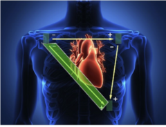 <p>Bipolar limb leads </p><p>lead II is suggested lead for diagnosing dysrhythmias for those rhythms that require a P wave for proper analysis</p>