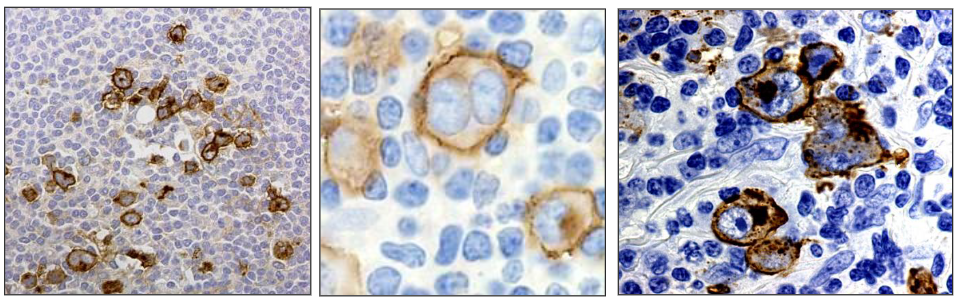 <p>Immunophenotyping:</p><p>- Reed-Sternberg cells express CD15 and CD30 antigens and are CD45 negative</p>