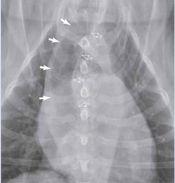 <p>dark white: right margin of trachea</p><p>light white arrow: left margin of trachea</p><p></p><ul><li><p>Lymphomegaly</p></li><li><p>Heart base mass</p></li></ul><p></p>