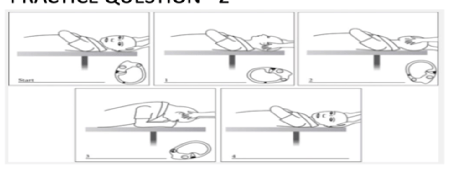 <p>B. Horizontal semicircular Canal BPPV in left Ear </p><p>This is BBQ roll. Left ear involved because it is the first side down.</p>