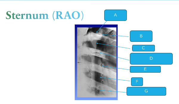 <p>what is B on this sternum RAO?</p>
