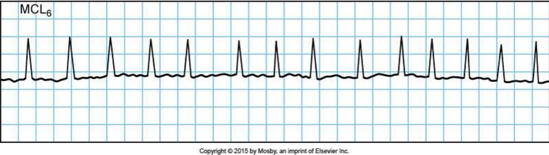 <p>Atrial fibrillation</p>
