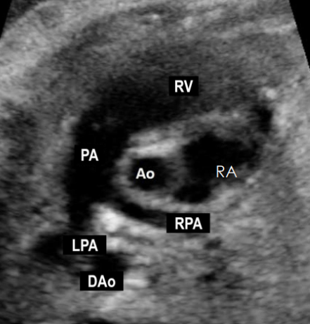 <ul><li><p><span style="background-color: transparent;">Pulmonary artery (PA)</span></p></li><li><p><span style="background-color: transparent;">Pulmonic valve (PV) </span></p></li><li><p><span style="background-color: transparent;">RV</span></p></li></ul><p></p>