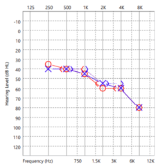 <p>describe the hearing loss</p>