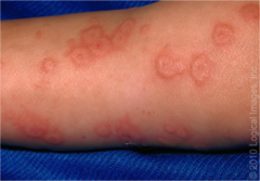 <p>aka EM minor</p><p>-sharply marginated, erythematous macules which become raised and edematous over 1-2 days</p><p>-acral predominance (palms/soles)</p><p>-typically a ring of erythema forms = 'target' </p><p>-strongly associated with preceding herpetic infection or Mycoplasma pneumonia</p>