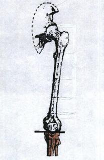 <ul><li><p>hip flexion </p></li><li><p>hip abduction </p></li><li><p>hip ER</p></li></ul><p></p>