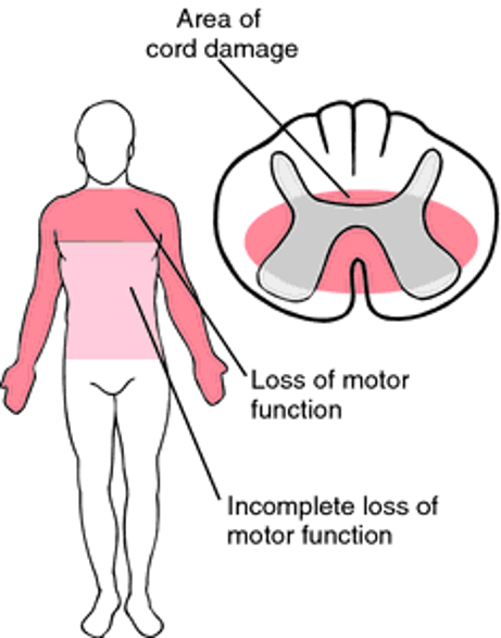 <ul><li><p>Injury to the center of the cord by edema and hemorrhage</p></li><li><p>Motor weakness and sensory loss in all extremities</p></li><li><p>Upper extremities affected more</p></li></ul><p></p>